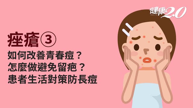 痤瘡／青春痘可以擠？青春痘如何快點好？患者7大生活對策免留疤