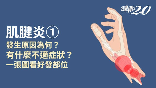 肌腱炎／為什麼會發生肌腱炎？肌腱炎有哪些症狀？肌腱炎好發身體4部位