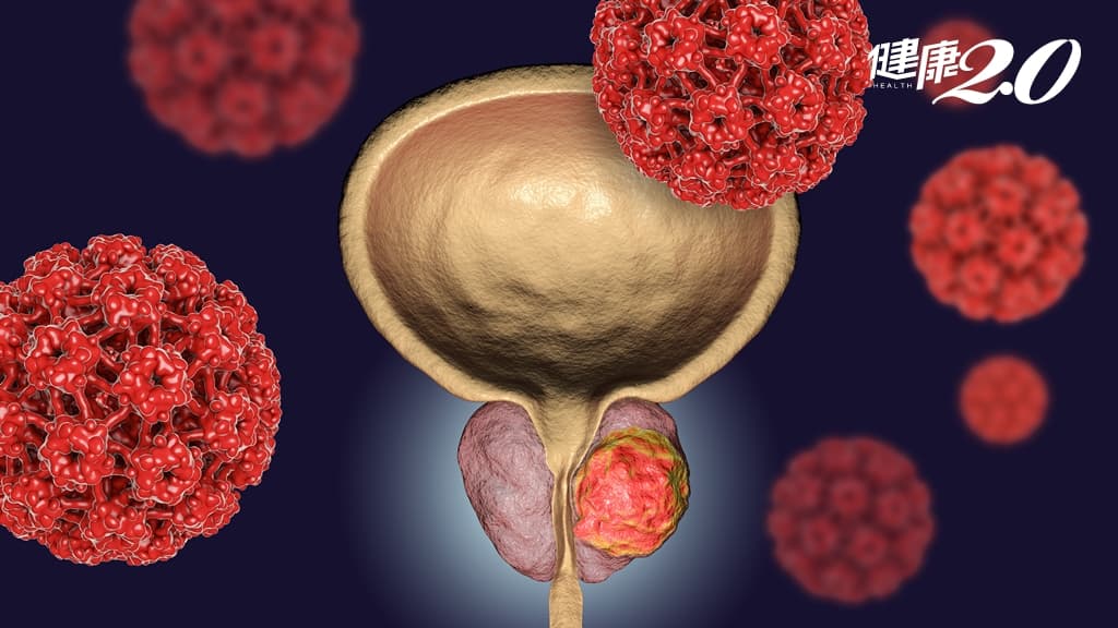 去勢抗性攝護腺癌新療法！國內首款「蛋白質降解藥物」抑癌效果達9成
