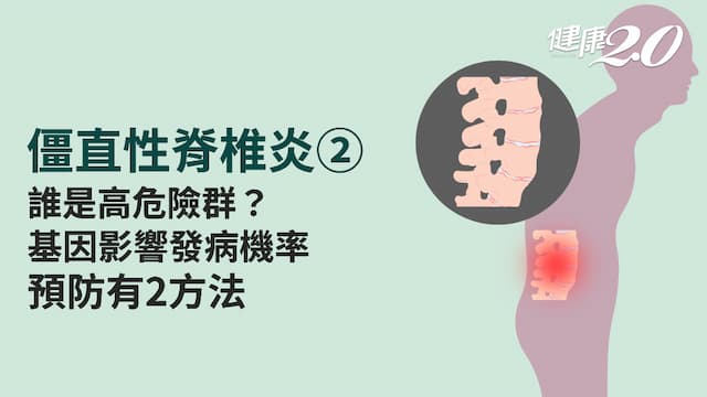 僵直性脊椎炎／誰是高危險群？帶有基因就一定發病嗎？預防方法看這裡