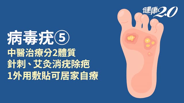 病毒疣／體質證型怎麼分？常用方劑有哪些？針灸1療法效果似電燒 敷貼皮膚可消疣
