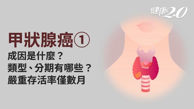 甲狀腺癌／甲狀腺癌有幾型？如何分期？「最溫和的癌」也有最惡性、存活僅數個月