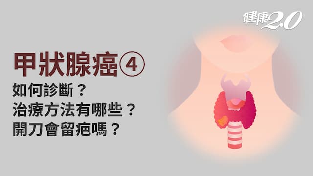 甲狀腺癌／該如何治療？治療方式有哪些？會有後遺症嗎？