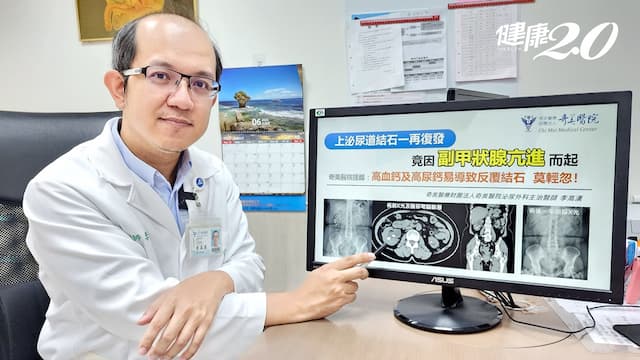 62歲女性反覆上泌尿道結石！竟是「副甲狀腺亢進」 1方法診斷 徹底治本不復發