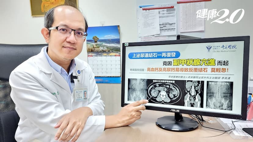 62歲女性反覆上泌尿道結石！竟是「副甲狀腺亢進」 1方法診斷 徹底治本不復發/medical/341304