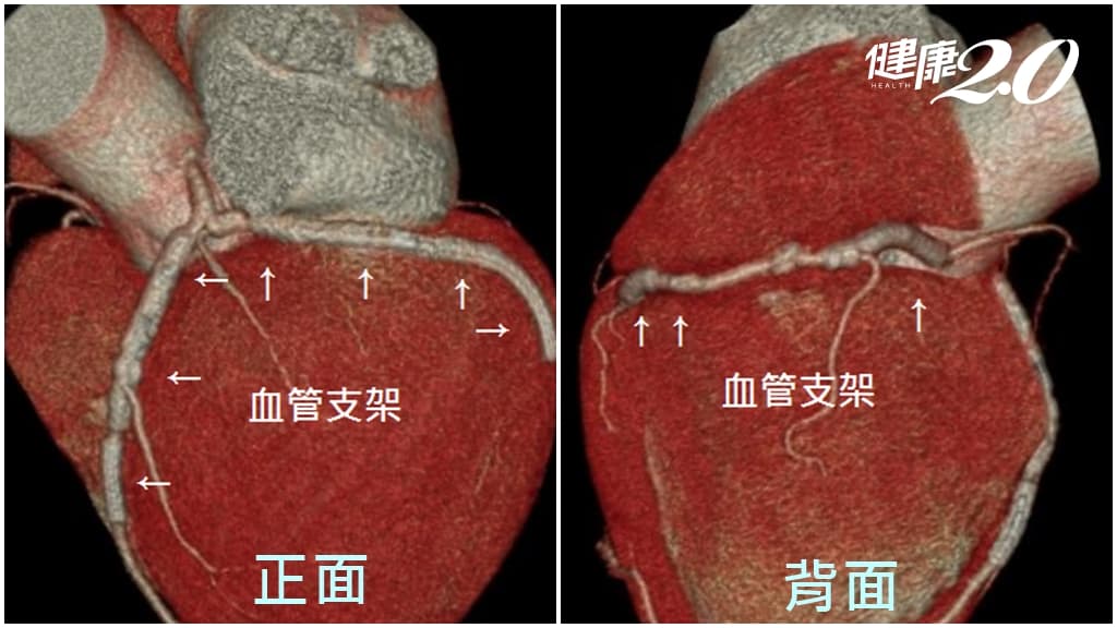 心肌梗塞 支架 光田