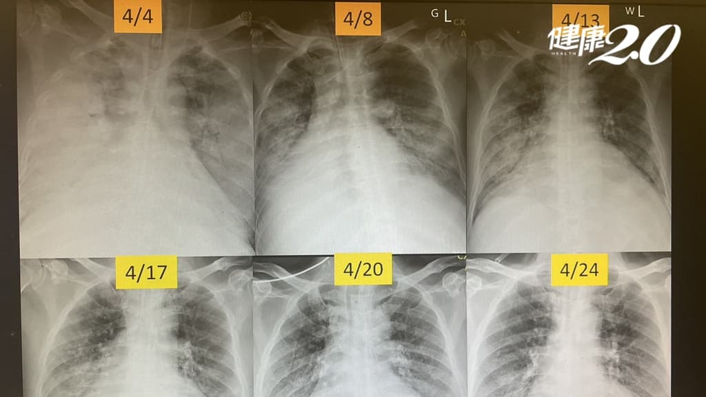 5旬男子血管炎肺全白了！一度急性呼吸窘迫險死 醫從鬼門關成功搶人