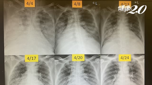5旬男子血管炎肺全白了！一度急性呼吸窘迫險死 醫從鬼門關成功搶人/medical/341631