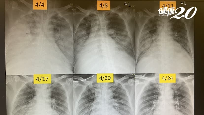 5旬男子血管炎肺全白了！一度急性呼吸窘迫險死 醫從鬼門關成功搶人/medical/341631