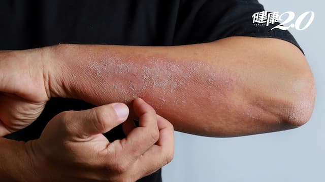 29萬國人有異位性皮膚炎！「2種新治療武器」可有效改善搔癢症狀