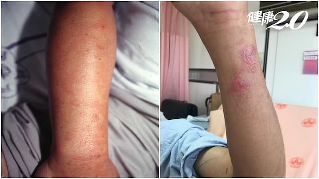 9月小心蜂螫！4情況恐致命 塗尿、塗氨都沒用 預防螫傷關鍵大公開