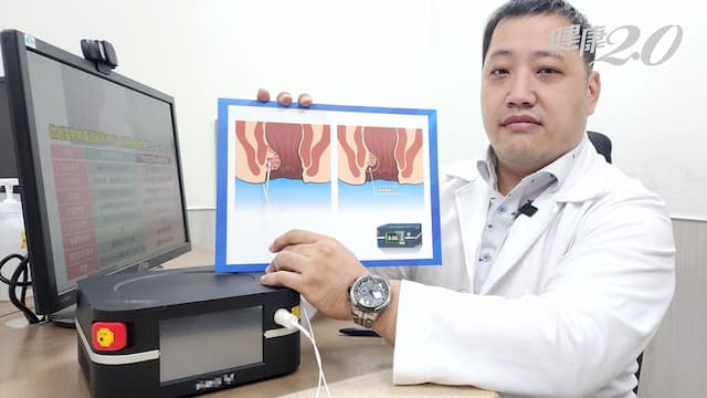 她痔瘡脫垂好難受，走路也會滑出！誰適合做「微創雷射痔瘡消融術」？