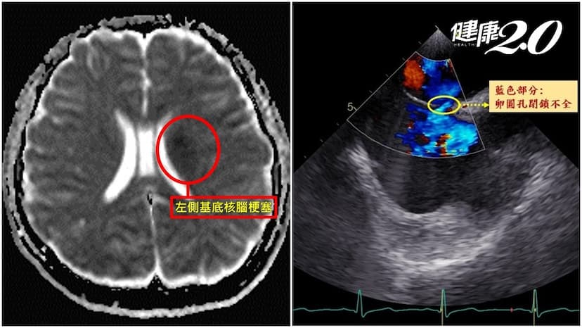 20歲女大生突發腦中風 原因竟是心臟病！偏頭痛患常有「開放性卵圓孔」須注意/medical/342279