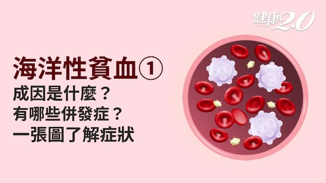 海洋性貧血／地中海型貧血是什麼？有哪些症狀？嚴重恐肝硬化、心臟衰竭
