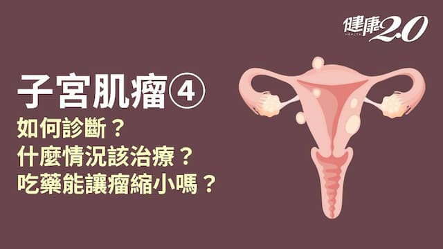 子宮肌瘤／沒有症狀需要治療嗎？切除肌瘤也必須切子宮？子宮肌瘤新療法看過來