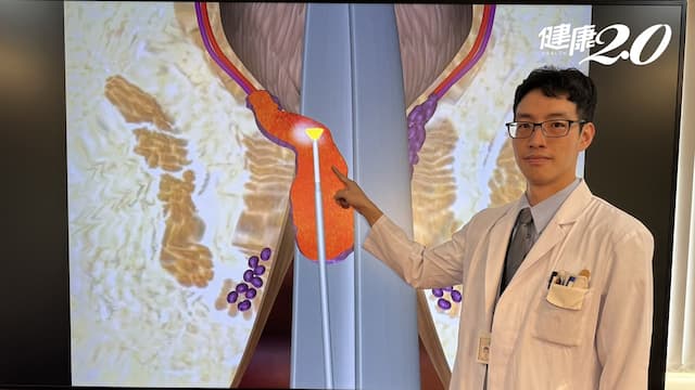 痔瘡手術無傷口！復發率比傳統切除更低 中榮痔瘡手術獲突破性進展 首度發布國際文獻