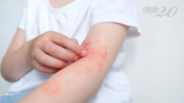 皮疹越抓越癢還長結節 當心「這罕病」上身！1顆發癢爆百顆 台大醫找到制癢新武器