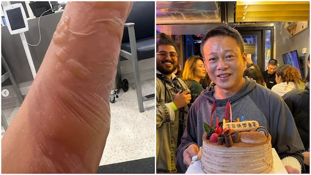 李康生遭滾水燙傷，手臂嚴重起泡！水泡破皮要撕嗎？1做法不留疤