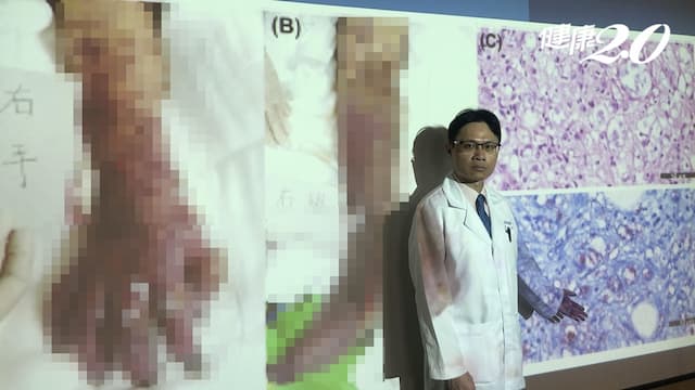 她皮膚四肢疼痛、冒紫斑！竟是漢生病超罕見症狀 四肢截肢仍去世