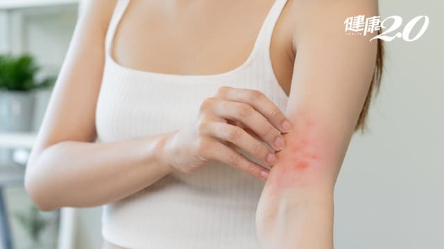 濕疹好不了？濕疹止癢方法？濕疹症狀、治療、藥膏懶人包
