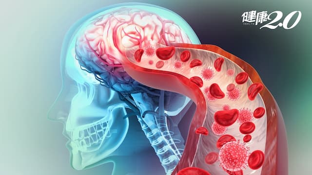 顱內血管狹窄恐奪命！什麼原因造成狹窄，用「新技術」一看便知 還能預測血栓風險
