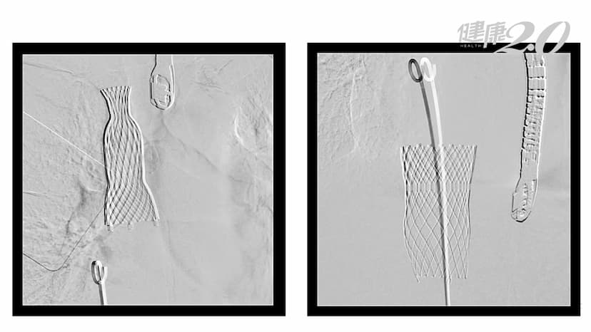 年紀大不堪開心手術 新醫材「幫心臟加2個瓣膜」救高齡心衰竭 台大醫院創亞洲首例/medical/343897