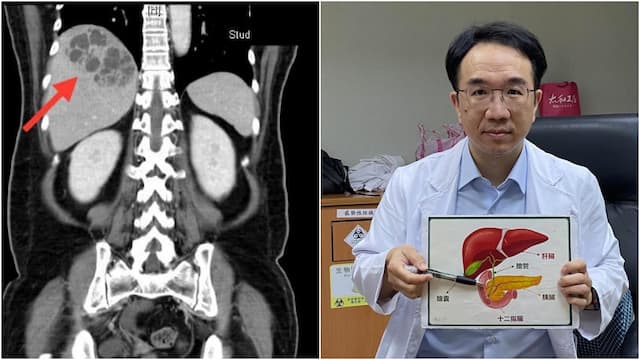 久咳治不好竟是肝癌！69歲男咳到喘不停 醫：久咳、打嗝不停小心