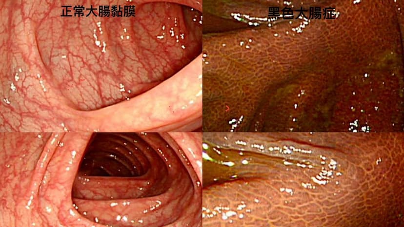 大腸變黑怎麼辦？黑腸症會致癌嗎？醫師揭祕長期瀉藥造成的大腸變化 1招治癒/medical/343998