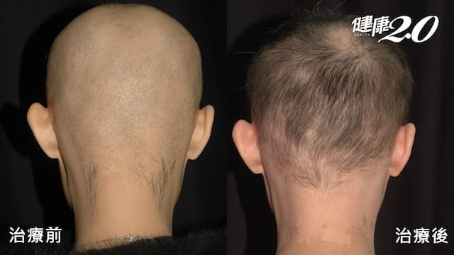 30歲女產後圓禿「頭髮幾乎掉光」台大醫研究「外用免疫療法」救回秀髮