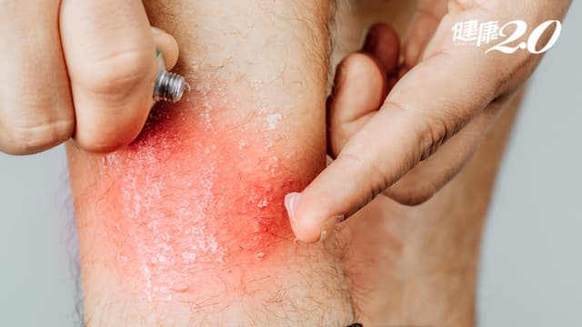 糖尿病容易皮膚癢！冬季癢乳液怎麼擦？冬季癢可以泡澡？這樣做預防皮膚癢