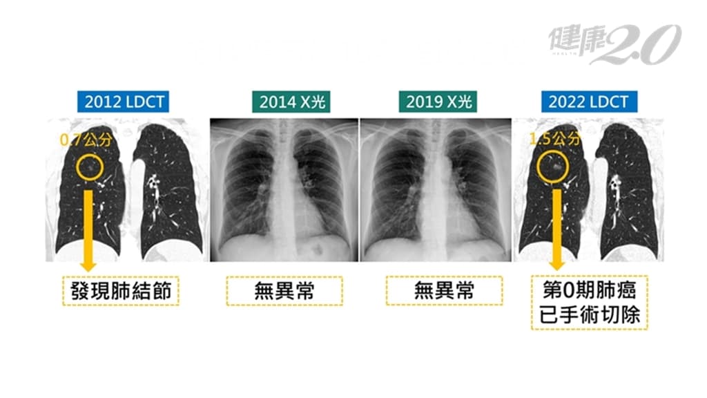 肺結節 肺癌 LDCT