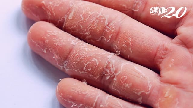 大掃除手脫皮好痛？清潔劑會傷手嗎？醫點出「護手4關鍵」預防刺激性皮膚炎