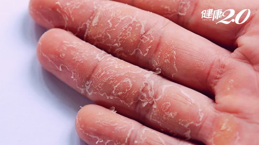 大掃除手脫皮好痛？清潔劑會傷手嗎？醫點出「護手4關鍵」預防刺激性皮膚炎/regimen/344682