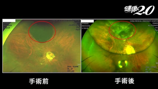 眼睛竟會長癌症！罕見眼癌致死率高 5旬婦「險摘眼球」複雜手術助成功留眼