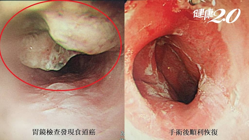 食道癌