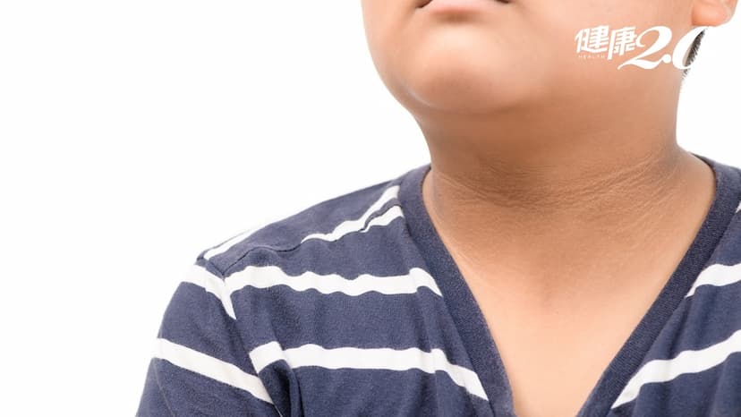 脖子黑洗不掉是糖尿病前兆嗎？黑色棘皮症在「嘴巴、手掌」恐罹患這些癌症/cancer/345244