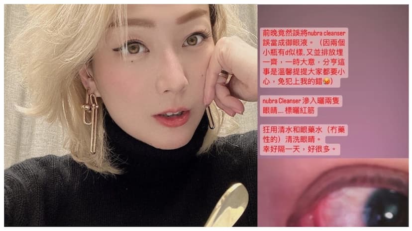 鄭秀文眼睛出狀況冒血絲！原來卸妝油用錯了 眼睛急救這樣做/medical/345330