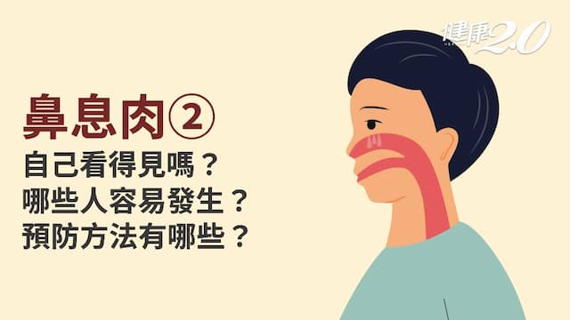 鼻息肉／鼻息肉高危險群？預防鼻息肉怎麼做？鼻息肉、鼻肉肥厚一樣嗎？