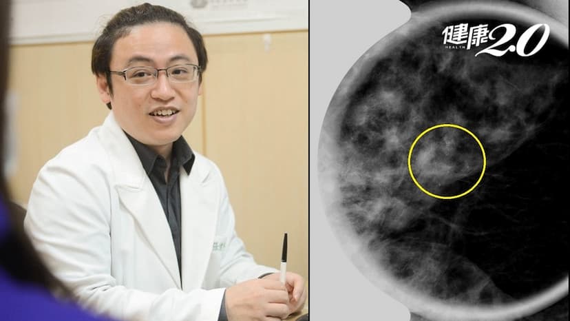 6旬婦無症狀確診乳癌！早期乳癌要切乳嗎？可以保留乳頭嗎？/cancer/345435
