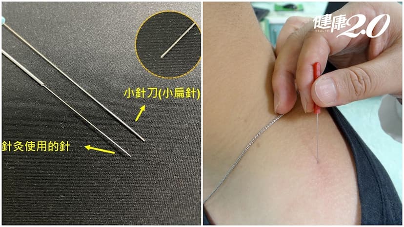 肩頸緊繃、肌肉僵硬，中醫「小扁針」鬆解筋骨！壯世代好發椎間孔狹窄也能治/strong/345583
