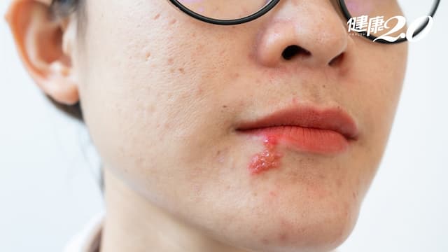 唇皰疹是什麼？嘴唇皰疹病毒如何感染？唇皰疹原因、症狀、治療