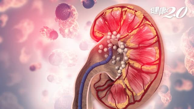 中藥傷腎？80歲男瀕洗腎，中醫治療化解洗腎危機！糖尿病吃中藥可降31％腎病風險