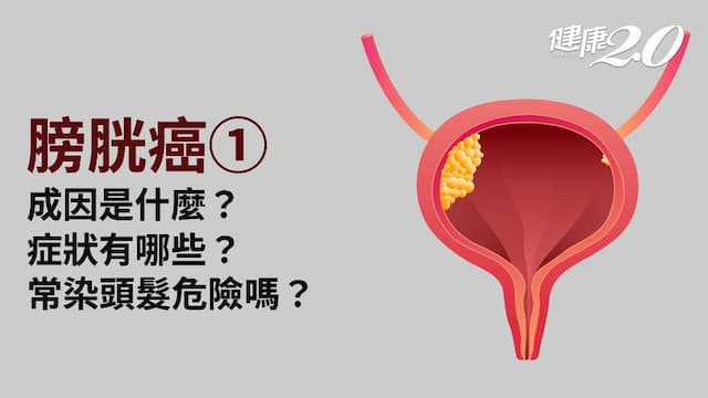 膀胱癌／膀胱癌有什麼症狀？染髮劑會致癌嗎？成因、併發症看過來
