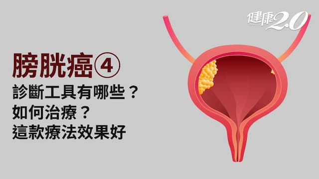 膀胱癌／膀胱鏡必要診斷工具 手術治療為主 膀胱灌注藥物預防再發