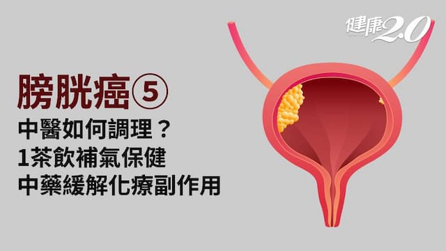 膀胱癌／體質辨證調理脾肺腎 壓5穴位助排尿順暢 中藥外敷生肌解痛