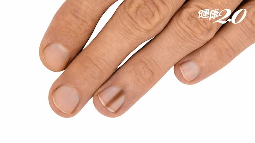 指甲黑線是癌症嗎？醫提醒：6狀況自我檢查 延誤就醫恐截指保命/medical/345977