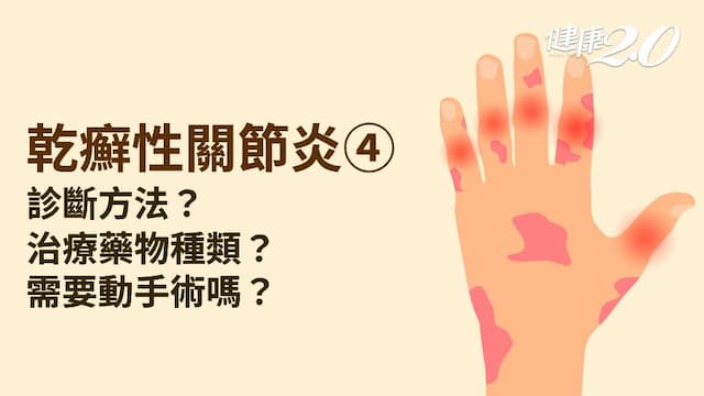 乾癬性關節炎／X光可以診斷乾癬性關節炎？先治療皮膚還是關節炎？哪種治療最有效？