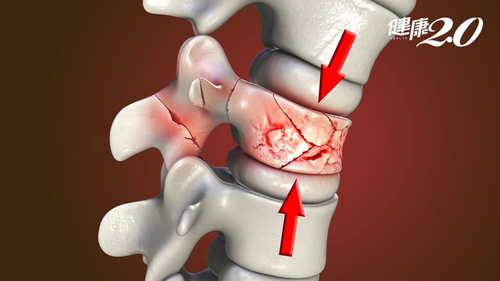 脊椎骨折