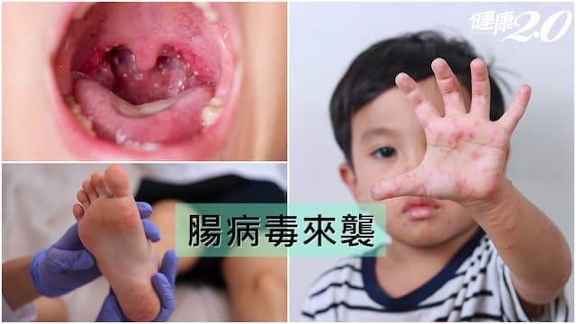 腸病毒症狀有哪些？腸病毒傳染途徑和停課標準懶人包