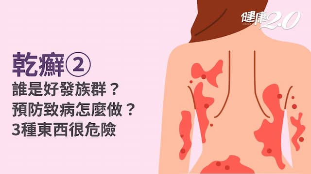 乾癬／危險族群有哪些？致病因子是什麼？6招預防乾癬